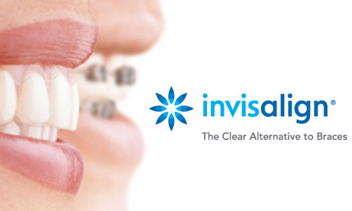 Invisalign Clear Aligners in Spring, TX